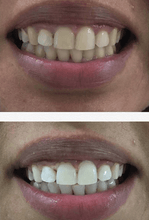 Load image into Gallery viewer, Turn Yellow Teeth White With The SNOW Whitening System