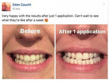 Load image into Gallery viewer, The Award Winning SNOW Teeth Whitening™ System