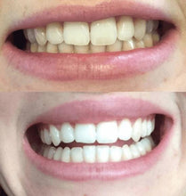 Load image into Gallery viewer, The Award Winning SNOW Teeth Whitening™ System