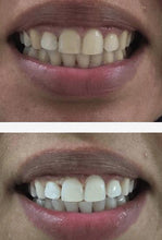 Load image into Gallery viewer, The Award Winning SNOW Teeth Whitening™ System
