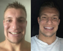 Load image into Gallery viewer, The Award Winning SNOW Teeth Whitening™ System