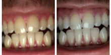Load image into Gallery viewer, The Award Winning SNOW Teeth Whitening™ System