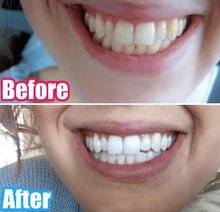 Load image into Gallery viewer, The Award Winning SNOW Teeth Whitening™ System