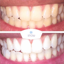 Load image into Gallery viewer, Turn Yellow Teeth White With The SNOW Whitening System
