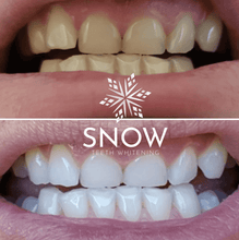Load image into Gallery viewer, Snow® At-Home Teeth Whitening Kit
