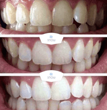Load image into Gallery viewer, Turn Yellow Teeth White With The SNOW Whitening System
