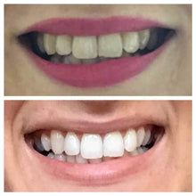 Load image into Gallery viewer, Snow® Teeth Whitening At-Home System [All-in-One Kit] - 15% OFF
