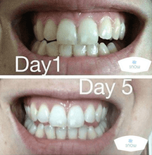 Load image into Gallery viewer, Turn Yellow Teeth White With The SNOW Whitening System
