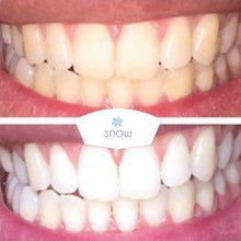Load image into Gallery viewer, The Award Winning SNOW Teeth Whitening™ System
